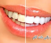 محلول های سفید کننده دندان