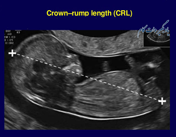 CRL یا طول فرق سر تا کفل در تخمین سن حاملگی
