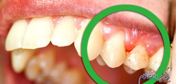 پوسیدگی دندان عامل بوی بد دهان 