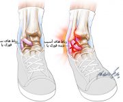 تمریناتی برای درمان و توانبخشی مچ پای آسیب دیده