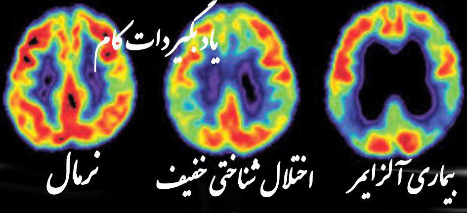 روند تغییر مغز در بیماری آلزایمر