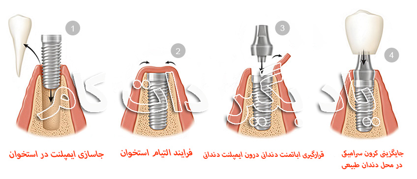 اینفوگراف مرحله به مرحله ایمپلنت دندانی