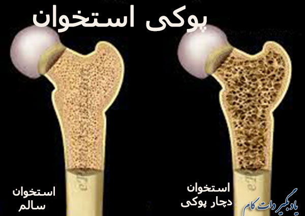 پیشگیری از پوکی استخوان در مردان 